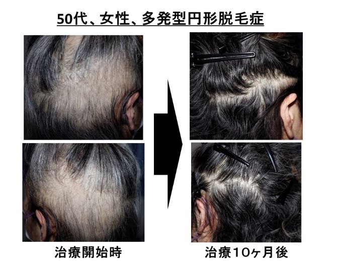 円形脱毛症　病院